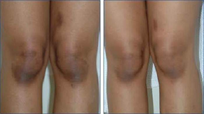 Te deranjează pielea întunecată de pe genunchi şi coate? Iată cât de uşor scapi de ea în doar 10 zile