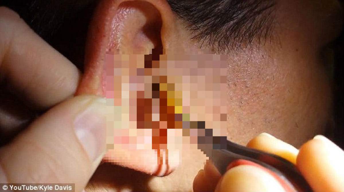 VIDEO / Înfricoşător de scârbos! Ce a descoperit  în urechea unui bărbat, după ce a folosit beţişoare de ureche