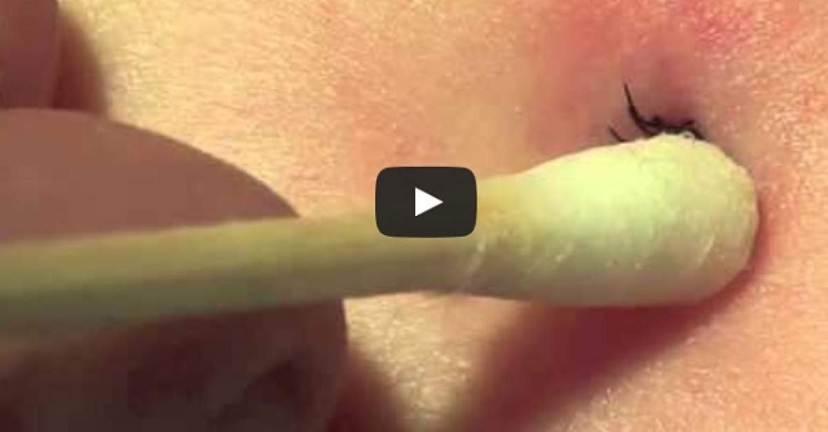 VIDEO / Cum se scoate corect şi fără durere o căpuşă din piele! E mai uşor decât te gândeai