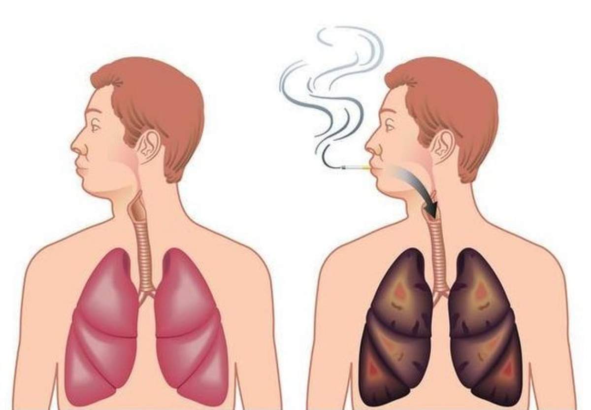 Eşti fumător? Vezi cum îţi poţi curăţa natural plămânii de nicotină