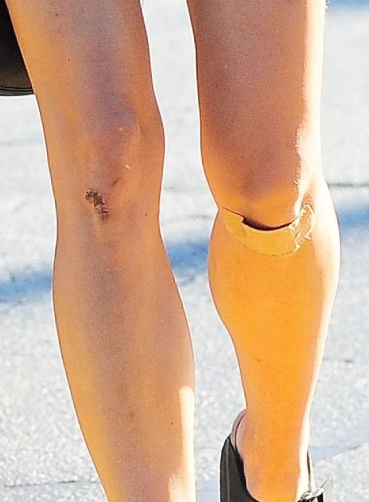 FOTO / O actriţă celebră, plină de vânătăi! A ieşit pe stradă cu picioarele bandajate