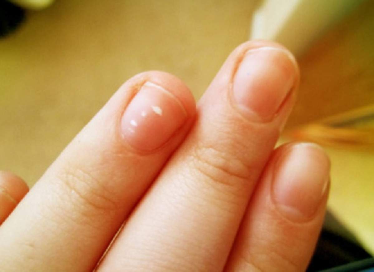 De ce apar petele albe pe unghii şi cum scapi de ele