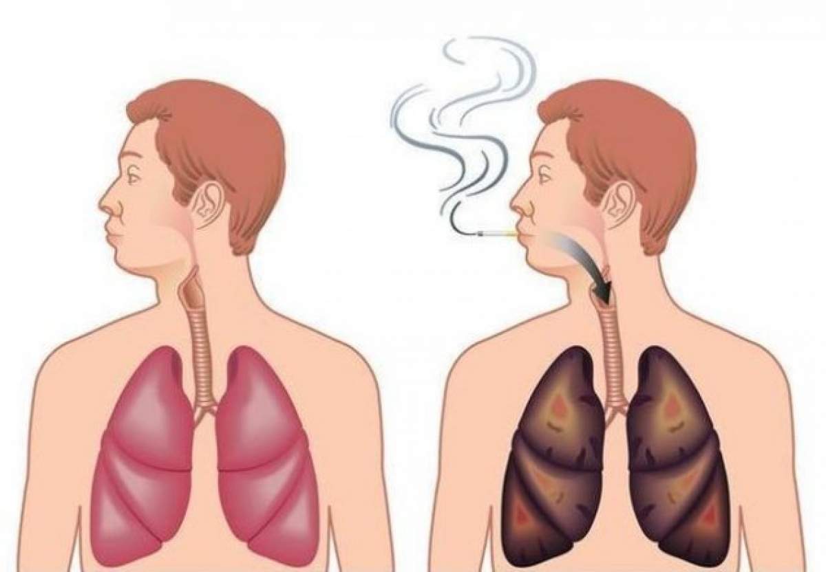 Eşti fumător? Această reţetă îţi curăţă plămânii de nicotină şi te face să scapi de viciu