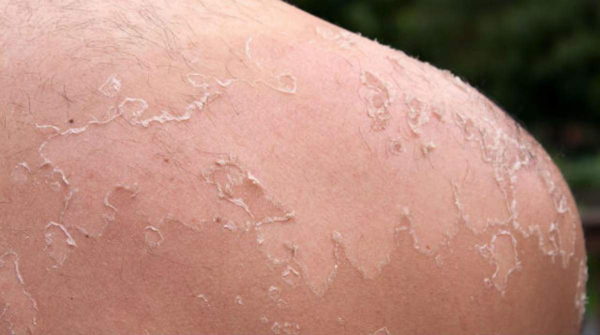 Cum să scapi de cojile de pe piele care se formează după ce te-ai ars la soare