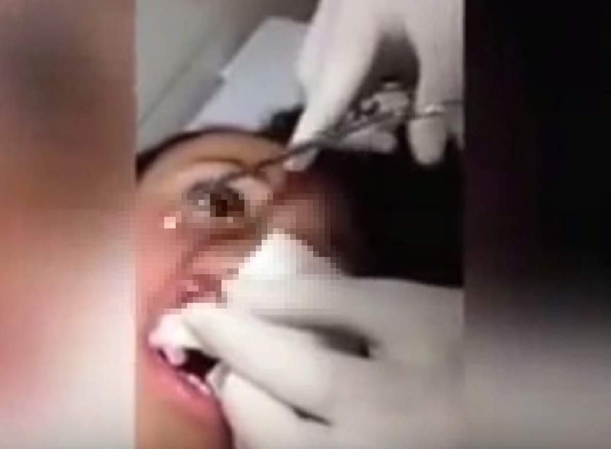 VIDEO / Greţos! Nu o să-ţi vine să crezi ce au descoperit medicii în buzele unei tinere