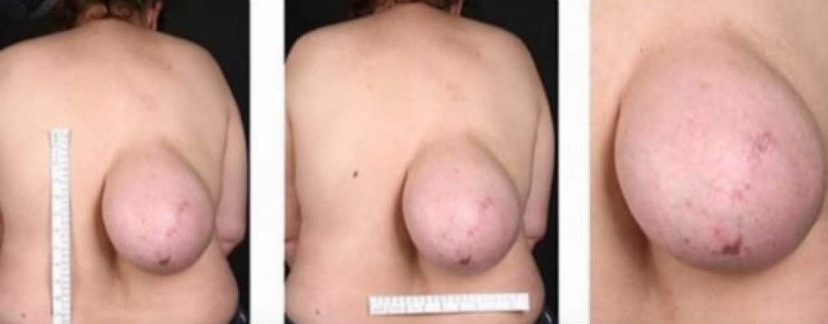 VIDEO / Caz şocant! Medicii au rămas fără cuvinte! Unei femei i-a crescut un "sân" pe spate