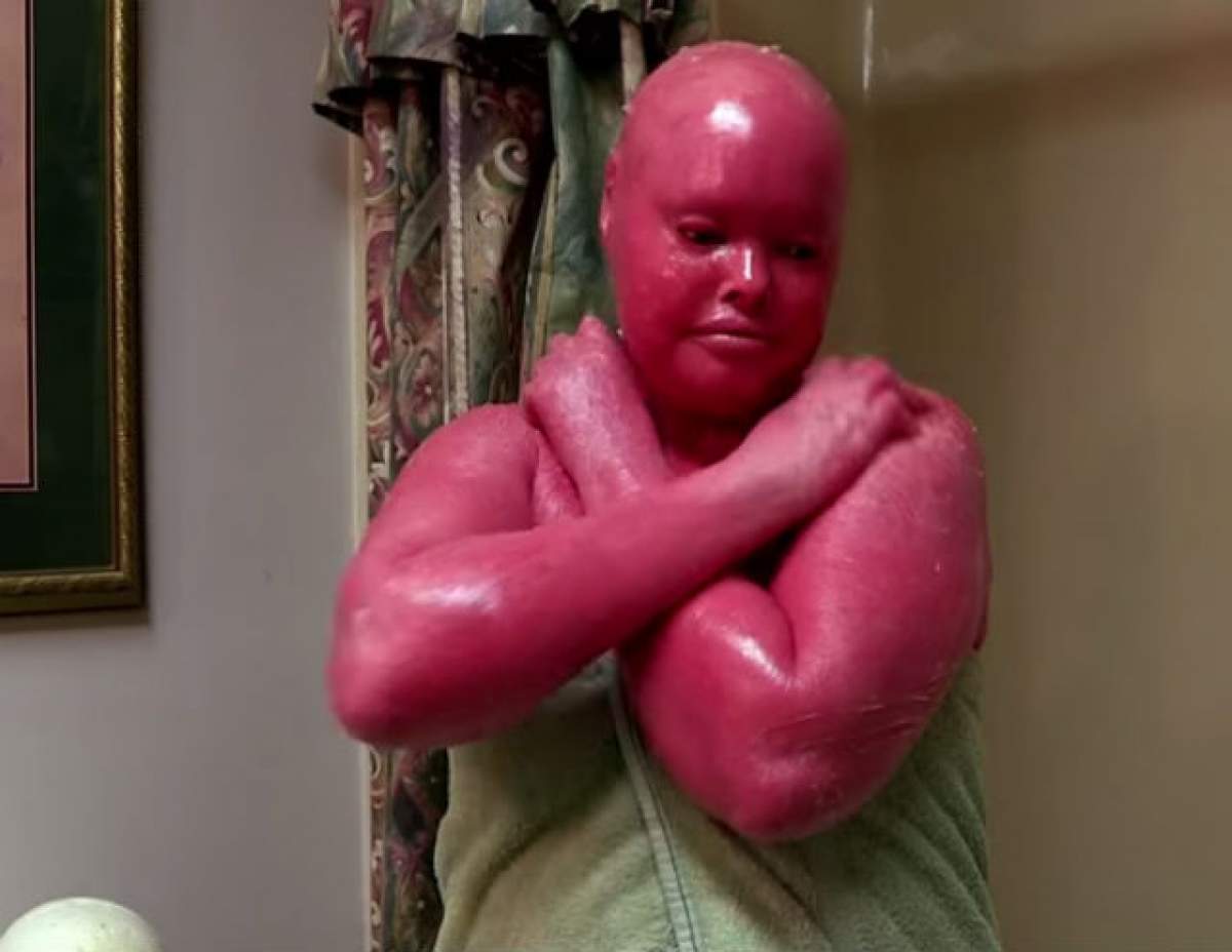 VIDEO / Suferă de o afecţiune gravă a pielii, iar imaginile cu ea sunt greu de privit! Ea este "femeia cu pielea roşie"