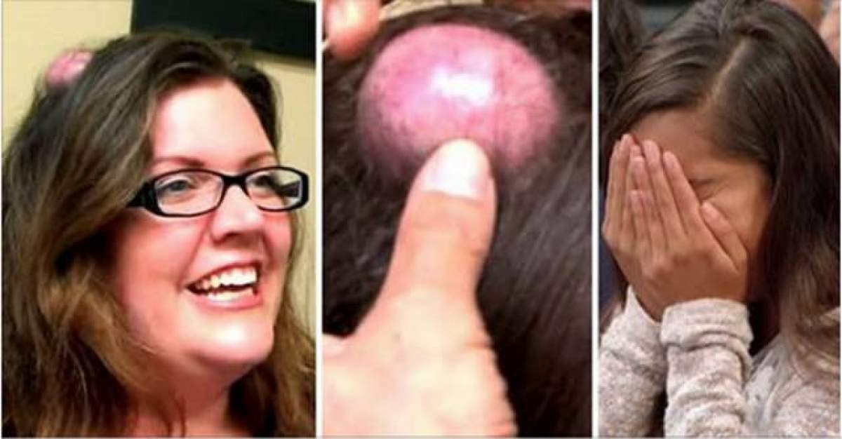 VIDEO / Imagini absolut dezgustătoare! A ajuns în faţa medicilor cu un chist în cap. Ce a urmat a oripilat lumea întreagă