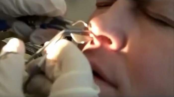 Dacă eşti sensibil, nu privi aceste imagini! Cum a reuşit un medic să elimine un muc imens din nasul unui pacient?