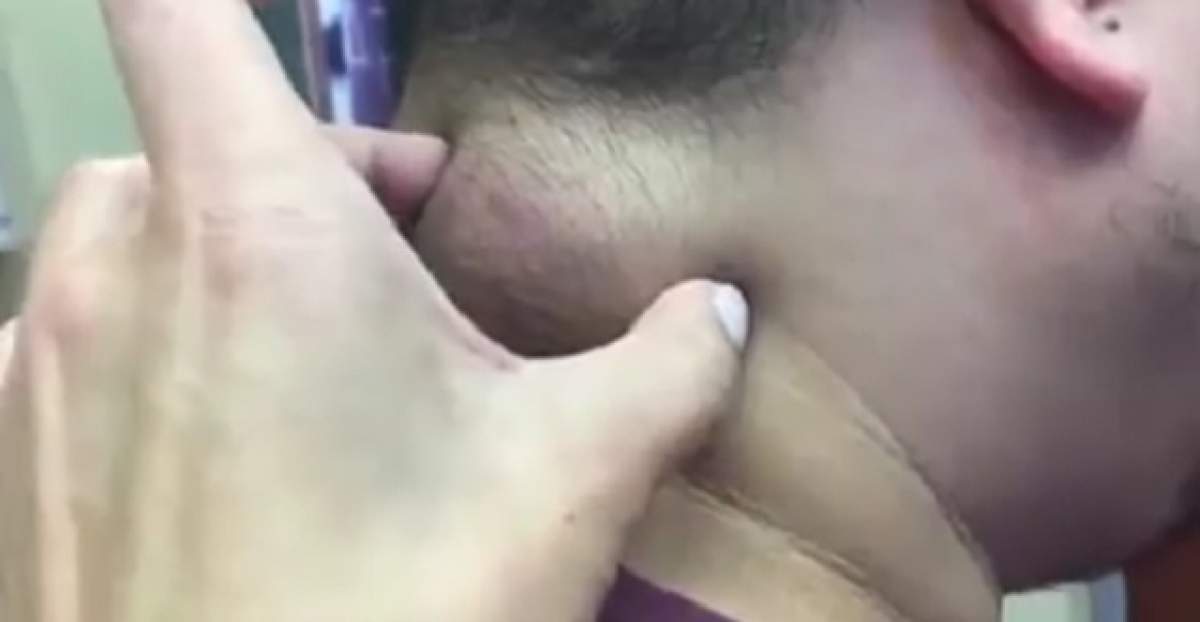 VIDEO / Dr. Pimple Popper loveşte din nou! Imaginile care îţi vor întoarce stomacul pe dos