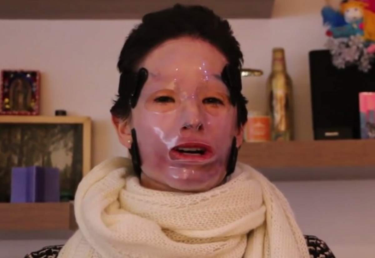 VIDEO / I-a fost aruncat acid sulfuric în faţă! După doi ani, aceasta a avut curajul să-şi scoată masca! IMAGINI CU IMPACT EMOŢIONAL