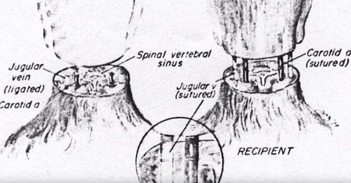 Dacă mori cu un corp sănătos, s-ar putea să fie vândut pe bani mulţi! Transplanturile de cap încep să fie efectuate pe oameni. Eşti de acord?