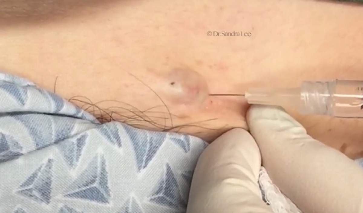 VIDEO / Avea o gâlmă pe piele deasupra unei zone INTIME şi a mers s-o scoată! Ce a ieşit din ea îţi va întoarce stomacul pe dos!