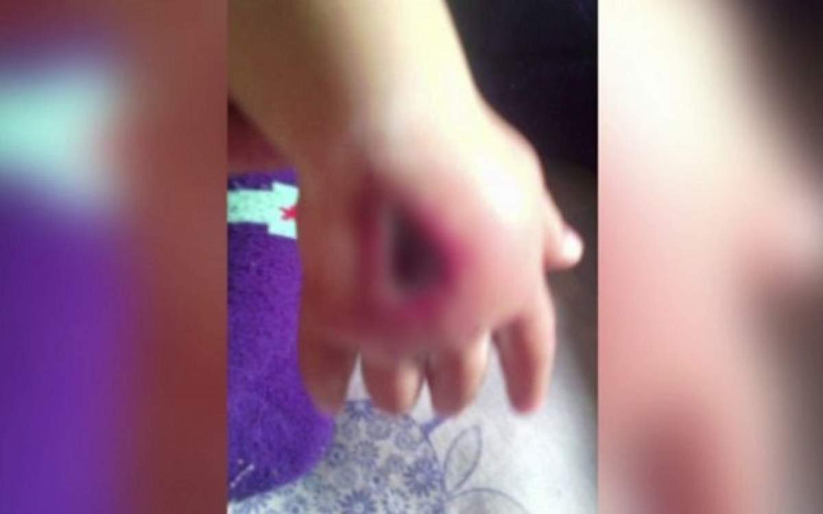 Caz şocant! Un copil de numai 9 luni s-a ales cu o gaură în mână din cauze unei branule!