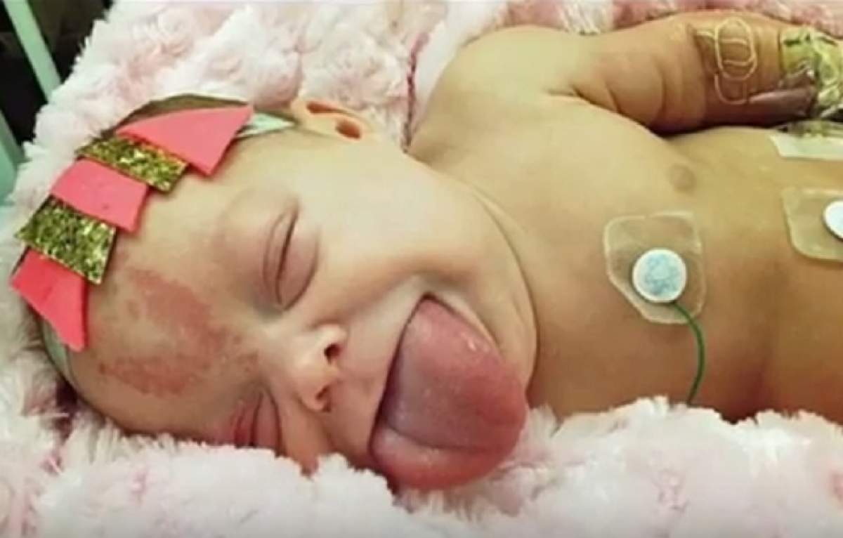 VIDEO / S-a născut cu limbă de adult şi gura n-o închidea. A fost operat şi de vrajă a scăpat! Cum arată acum copilul "broscuţă"