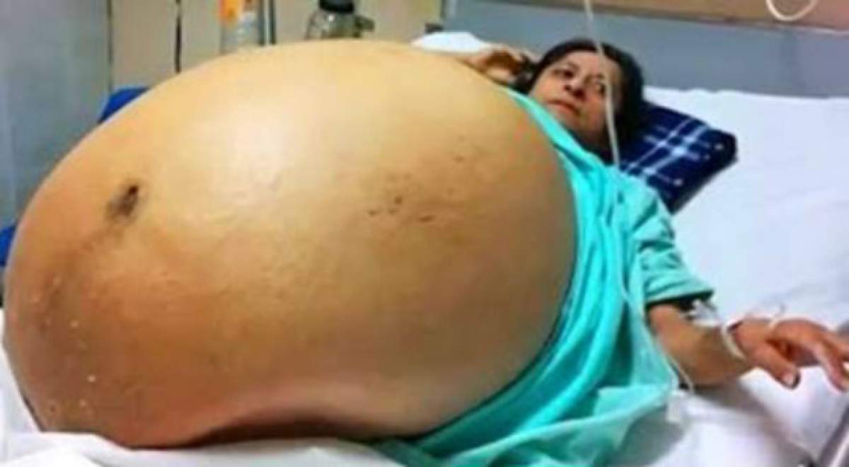 FOTO / Caz unic în Australia! A avut o burtă de parcă avea cvadrupleţi, dar medicii au fost şocaţi când au început cezariana! Ce au descoperit