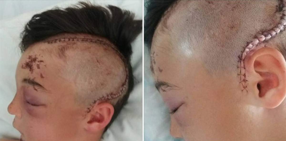 FOTO / Accidentul care a marcat PE VIAȚĂ un copil de 14 ani: a SURZIT cu o ureche. Mesajul mamei după incident