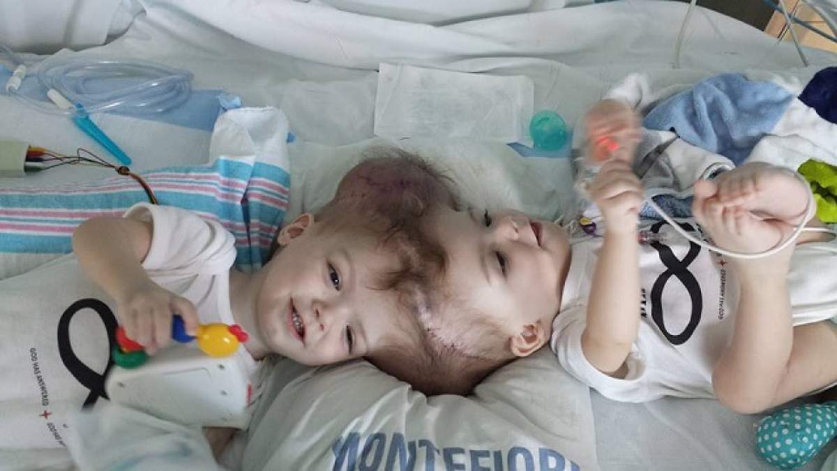 FOTO / Siamezi, separaţi după o operaţie craniană maraton ce a durat 20 de ore. Imagini impresionante cu cei doi copilaşi , la scurt timp după intervenţie