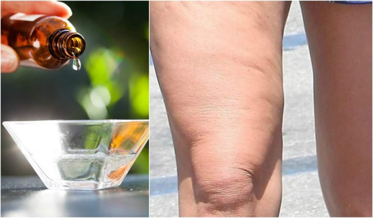 Leacul pentru celulită, închis într-o sticlă de 10ml! Trucul floare la ureche pentru o piele catifelată