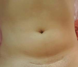 FOTO / A adus pe lume un copil unic şi acum şi-a pozat operaţia de cezariană! Aşa arată abdomenul transsexualului care a uimit lumea