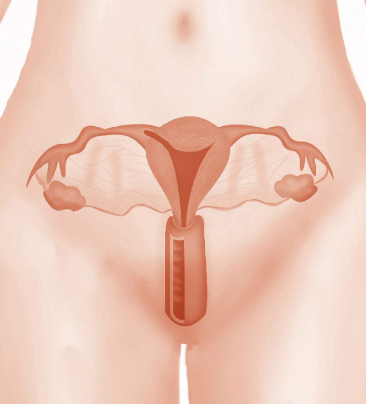 Sindromul ovarelor polichistice. Peste 50% din femei nu prezintă simptome ale acestei boli periculoase