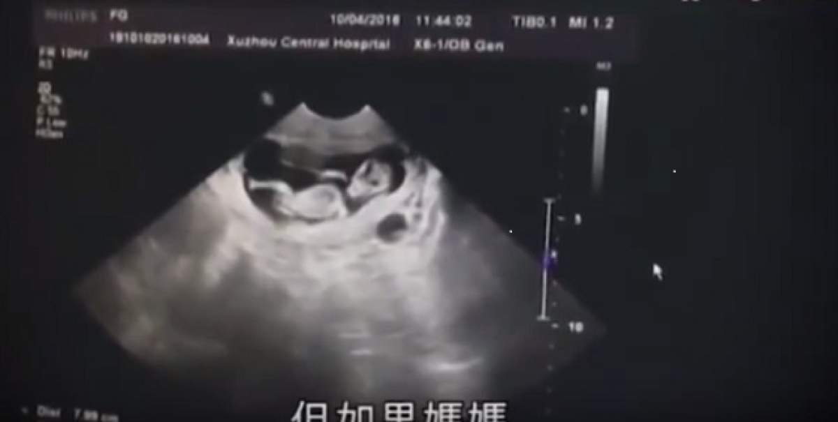 VIDEO / O fetiţă de 12 ani gravidă adusă la spital, de urgenţă. Medicii au chemat poliţia când au aflat cine e tatăl copilului