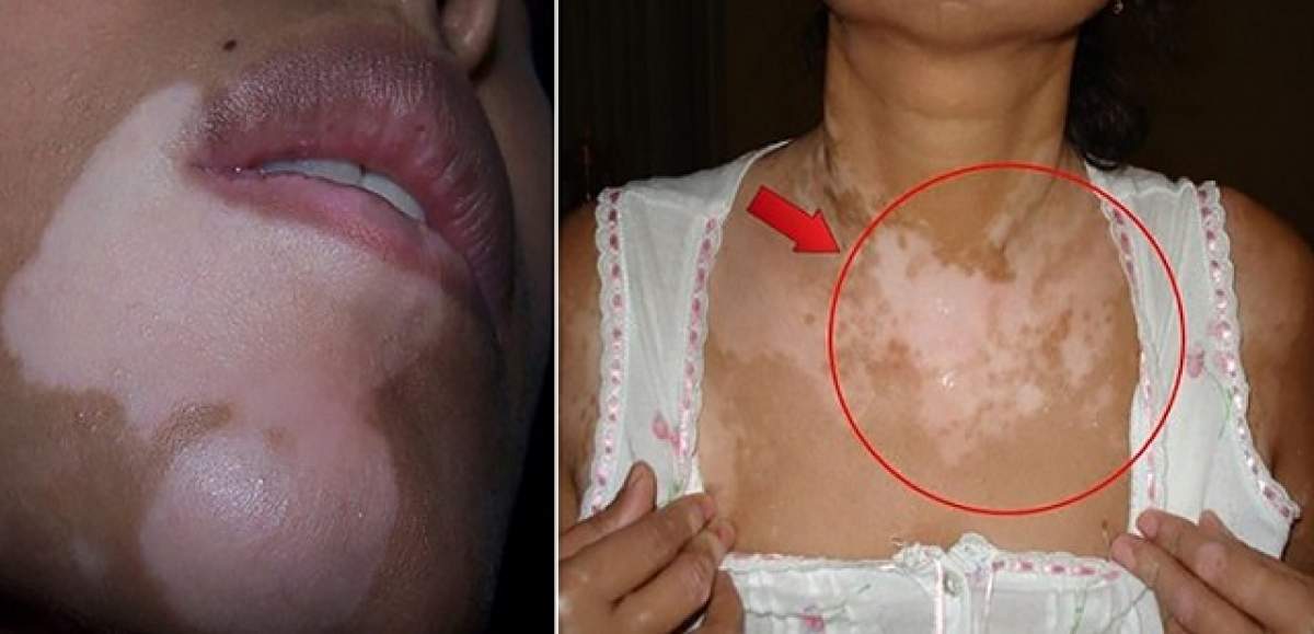 Cum să scapi de petele de pe piele provocate de boala "Vitiligo"! Ai tratamentul acasă