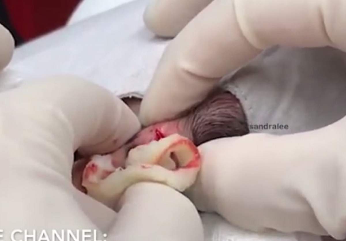 VIDEO / Cum arată un un chist uriaş, în timpul procedurii de extragere. Imaginile nu sunt pentru oricine