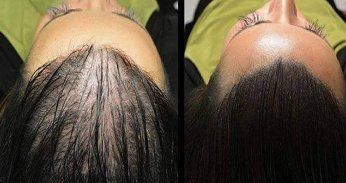 Aplică-ţi asta pe păr şi UITĂ DE CHELIE! Remediul împotriva căderii părului care NU DĂ GREŞ