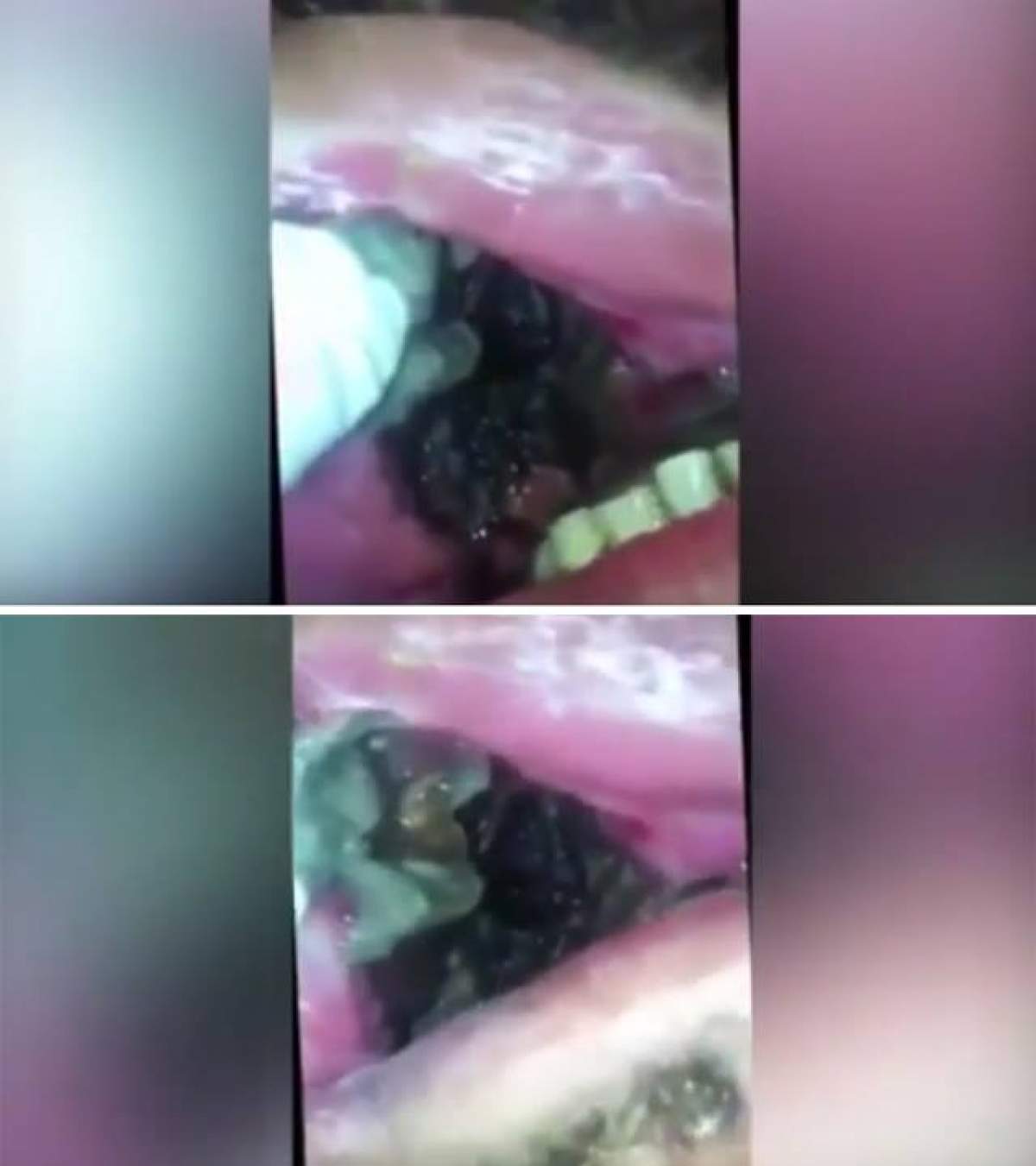 VIDEO /  Este un adevărat coşmar macabru! A deschis gura, iar doctorul dentist s-a speriat când s-a uitat înăuntru