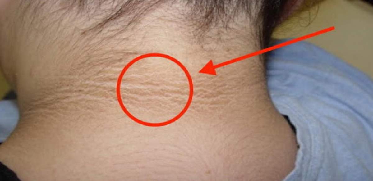 Ți-a apărut un cerc întunecat pe pielea din jurul gâtului? Înseamnă că ai probleme grave de sănătate! Află ce semnifică el