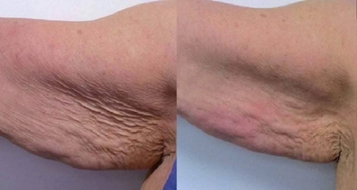 Cum să scapi de celulită şi de grăsimea de pe braţe? Patru paşi simpli pe care trebuie să-i urmezi!