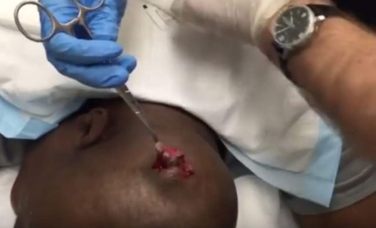 VIDEO / Trebuie să ai stomacul tare ca să priveşti asta. Unui bărbat i se extirpă un chist din cap. Medicul taie în carne vie, dar el vorbeşte