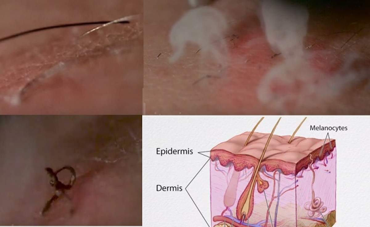 VIDEO / Epilatul definitiv, în slow-motion! Ce se întâmplă cu firele de păr când sunt lovite de razele laser