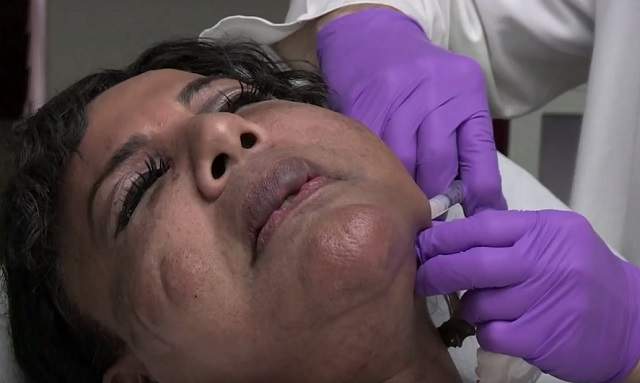 FOTO & VIDEO / Şi-a injectat faţa, iar la puţin timp chipul i-a devenit un bolovan! Cum arată femeia cu fălci "de ciment"