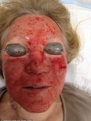 FOTO ŞOCANT! Suferă baba la frumuseţe! Plătesc 1.200 de dolari pentru un tratament facial cu laser care-i lasă cu chipul distrus: "Am fost crucificată"
