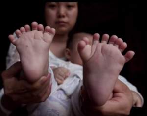 FOTO / Cazul incredibil ce a şocat medicii! Cum arată băiatul care s-a născut cu 31 de degete la mâini şi picioare