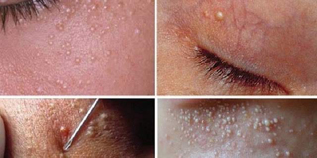 Cum Să Scapi De Milia Afecţiunea Punctelor Albe De Pe Faţă Iţi Ia Trei Minute Spynews Ro Cum Să Scapi De Milia Afecţiunea Punctelor Albe De Pe Faţă Iţi Ia Trei Minute Spynews Ro