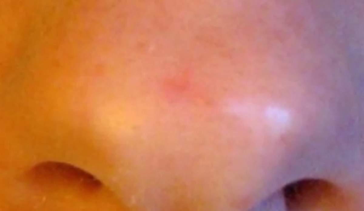 VIDEO / I-a putrezit faţa la propriu! O femeie a rămas fără jumătate din nas din cauza unui remediu naturist pentru cancer