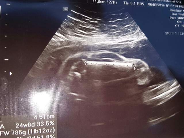 O gravidă a mers la ecografie şi a descoperit că asteaptă un BEBELUŞ - MAŞINĂ! Părinţilor nu le-a venit să creadă cum arată şi au făcut poza publică. Imaginea a devenit virală