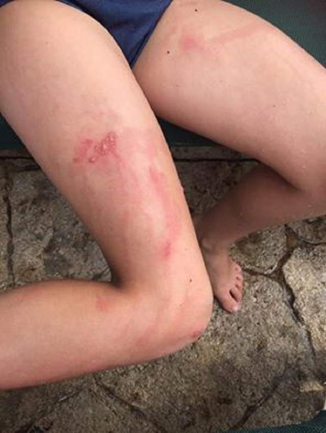 Şi-a dat fetiţa de 9 ani cu soluţie pentru protecţie solară, iar micuţa a ajuns de urgenţă la SPITAL! Medicii au fost îngroziţi când au văzut ce era pe corpul ei