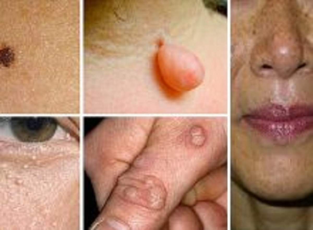 Vrei să scapi de aluniţe şi negi? Trebuie doar să deschizi frigiderul!