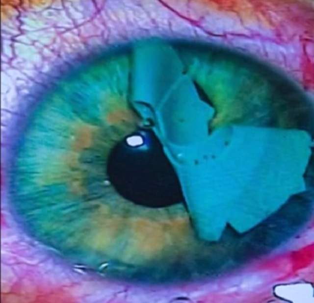 Femeia cu talie de viespe a plătit 4000 de lire pentru a avea ochii verde cariocă! Cum arată după ce şi-a dat bandajul jos