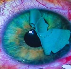 Femeia cu talie de viespe a plătit 4000 de lire pentru a avea ochii verde cariocă! Cum arată după ce şi-a dat bandajul jos