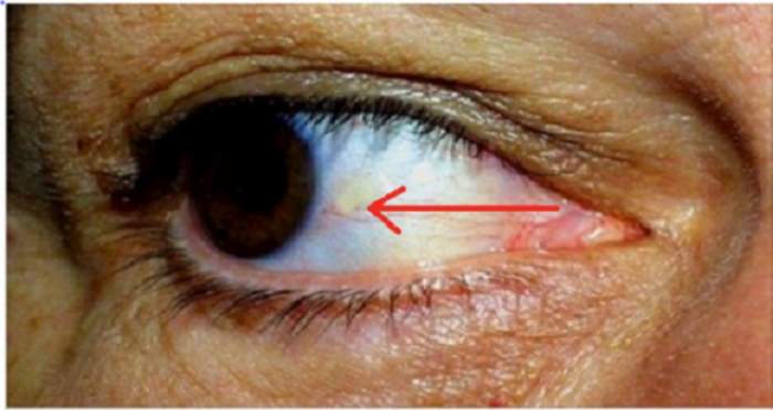 SarcoidosisUK - Sarcoidosis and The Eye