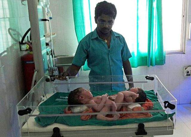 VIDEO / Caz tulburător! Doi bebeluși s-au născut lipiți, iar situația este una la care nici medicii nu se așteptau! Ce îi deosebește de alți siamezi