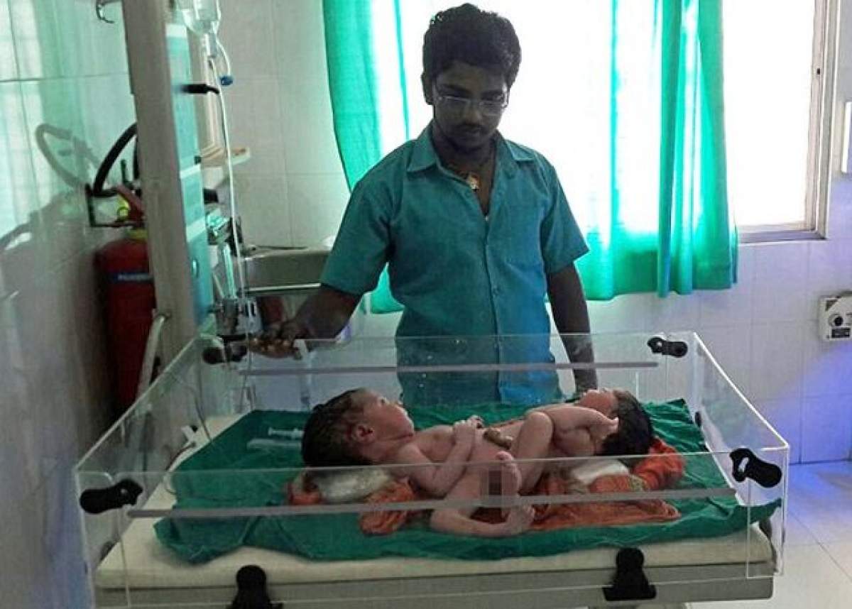 VIDEO / Caz tulburător! Doi bebeluși s-au născut lipiți, iar situația este una la care nici medicii nu se așteptau! Ce îi deosebește de alți siamezi