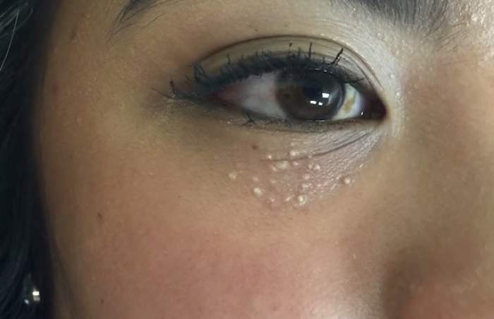 Video Ai Observat Vreodată Puncte Albe Pe Ochi Sau Nas Uite Ce Inseamnă Si Cum Poţi