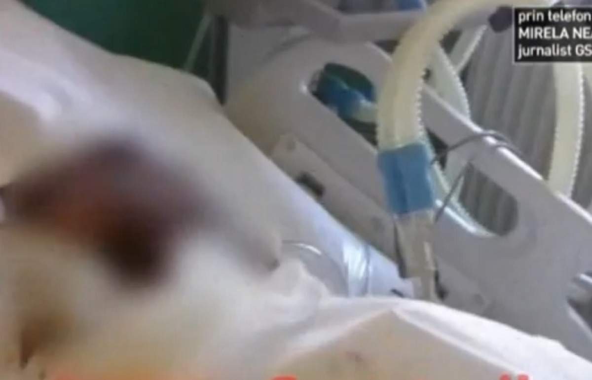 VIDEO / Imagini ŞOCANTE filmate de un medic de la Spitalul de Arși. Pacient cu larve de muscă direct pe rană