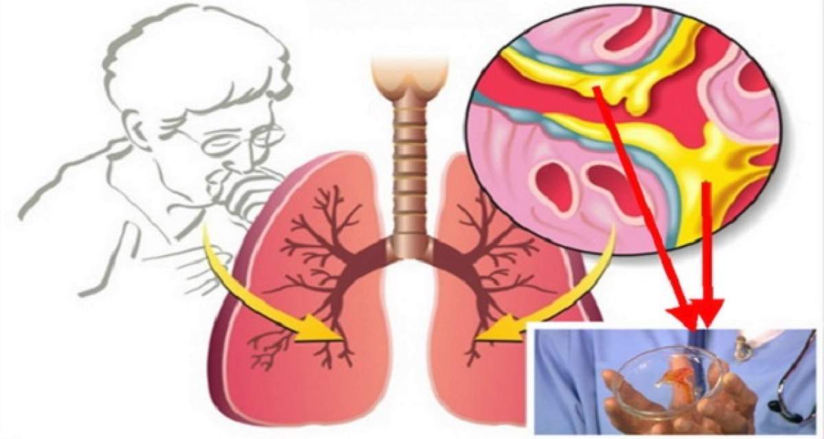 Tusea - oglinda sănătăţii tale! Modul în care expectorezi îţi spune de ce boală suferi
